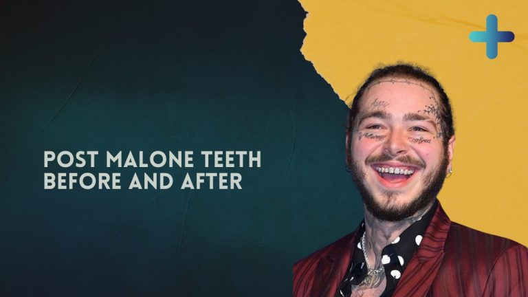 post malone teeth before and after