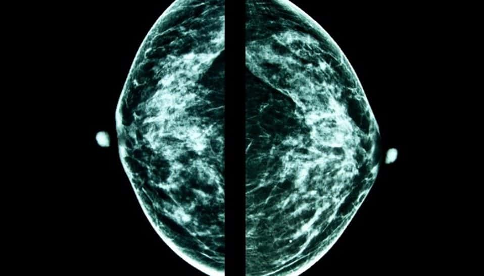 Breast Cancer Overdiagnosis Concerns