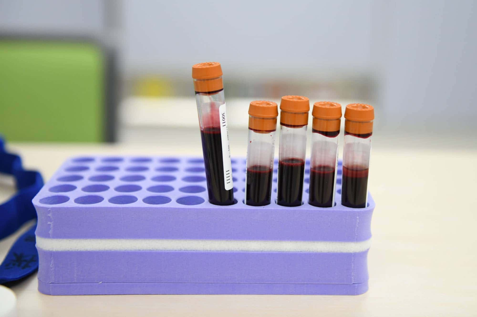 Breakthrough Alzheimer’s Blood Test Offers Early Detection and Proactive Management