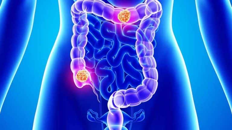 Doctors Who Treat Colon Cancer Stress Importance of Screenings and Lifestyle Choices in Prevention