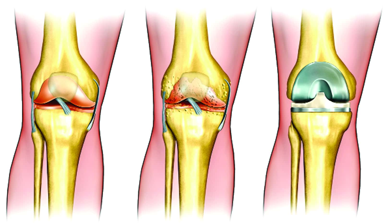 Robert Fleetwood's Revolutionary Knee Replacements Showcase Advances in Same-Day Procedures and Active Aging