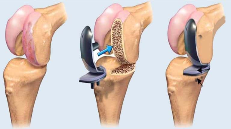 Robert Fleetwood's Revolutionary Knee Replacements Showcase Advances in Same-Day Procedures and Active Aging