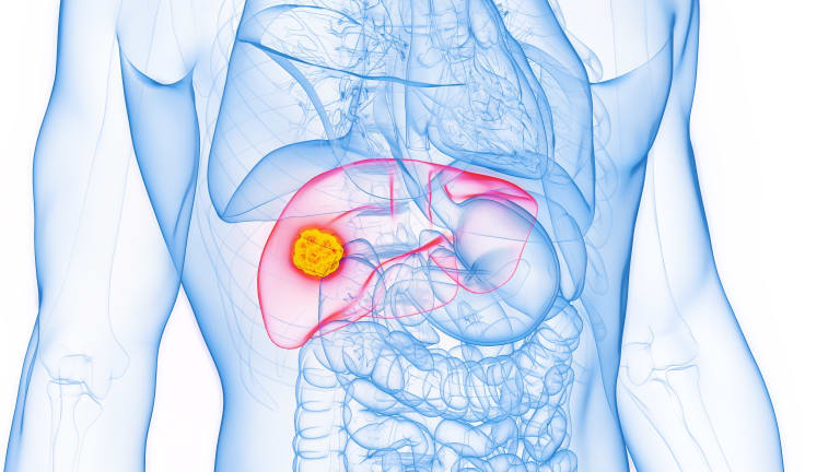 Hepatocellular Carcinoma: Durvalumab and Bevacizumab Combination Almost Doubles Progression-Free Survival